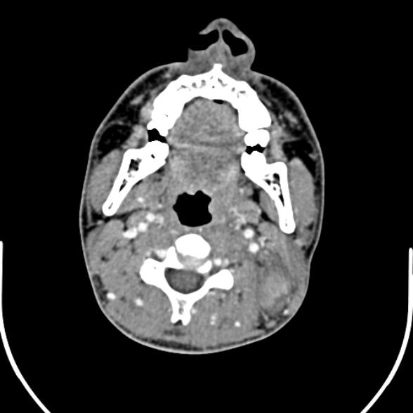Nasopharyngeal carcinoma with skull base invasion (Radiopaedia 53415-59705 A 96).jpg
