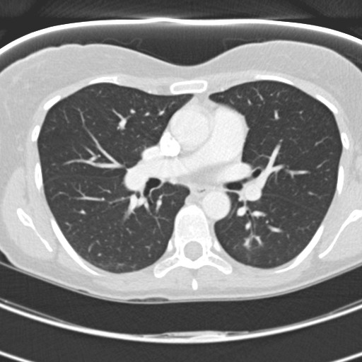 Necrobiotic pulmonary nodules - Crohn disease (Radiopaedia 20723-20631 Axial lung window 66).jpg