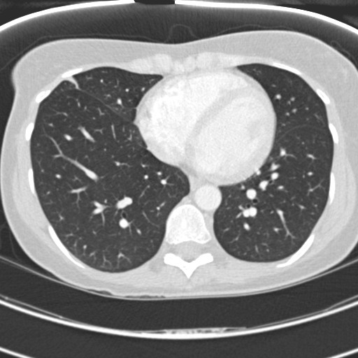 Necrobiotic pulmonary nodules - Crohn disease (Radiopaedia 20723-20631 Axial lung window 96).jpg