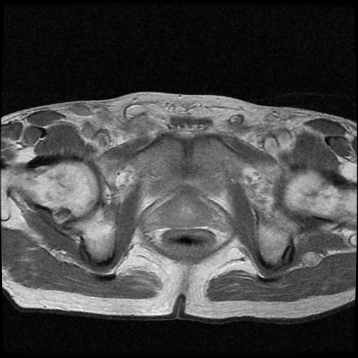 File:Necrotizing epididymo-orchitis with intra-testicular abscess (Radiopaedia 29397-29860 Axial T1 C+ 4).jpg