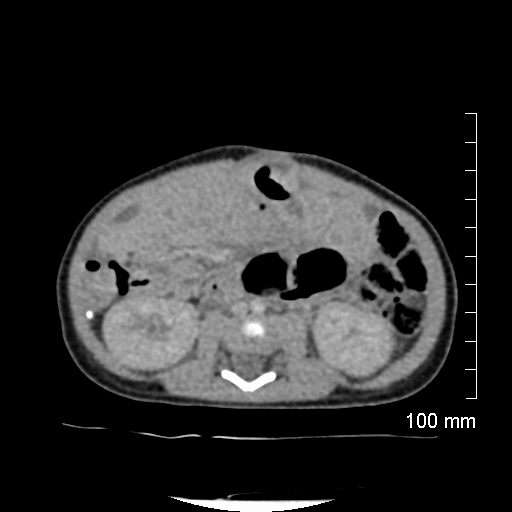 File:Neonatal neuroblastoma (Radiopaedia 56651-63438 Axial non-contrast 48).jpg