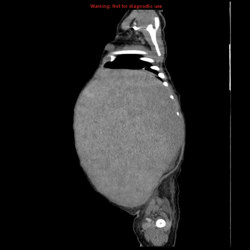 File:Neonatal neuroblastoma (Radiopaedia 9564-10223 C 30).jpg