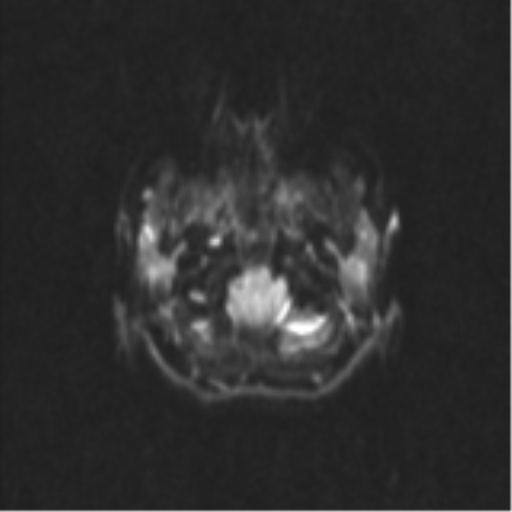 Neurenteric cyst (Radiopaedia 58641-65837 Axial DWI 4).png