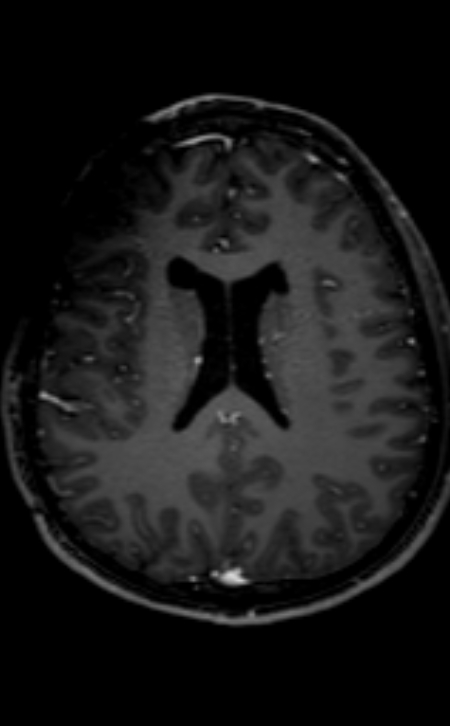 Neuro-Behçet disease (Radiopaedia 90112-107294 Axial T1 C+ 109).jpg