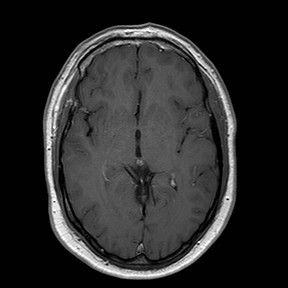 File:Neuro-Behcet's disease (Radiopaedia 21557-21506 Axial T1 C+ 14).jpg