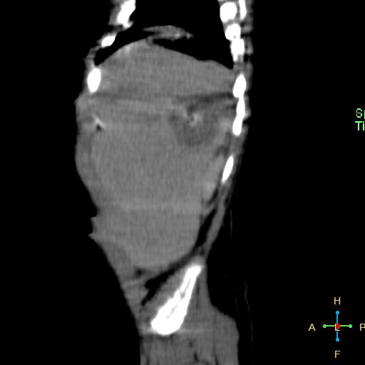 File:Neuroblastoma (Radiopaedia 24751-25016 C 27).jpg