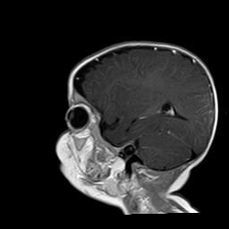 File:Neurofibromatosis type 1 (Radiopaedia 30089-30671 Sagittal T1 C+ 3).jpg