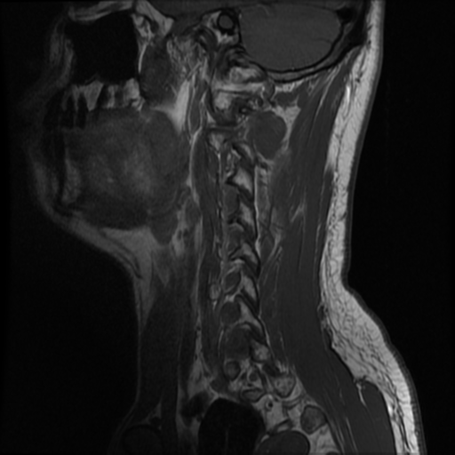 File:Neurofibromatosis type 2 (Radiopaedia 44936-48837 Sagittal T1 14).png