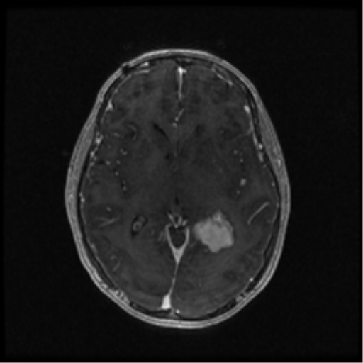 Neurofibromatosis type 2 (Radiopaedia 45229-49244 Axial T1 C+ 63).png