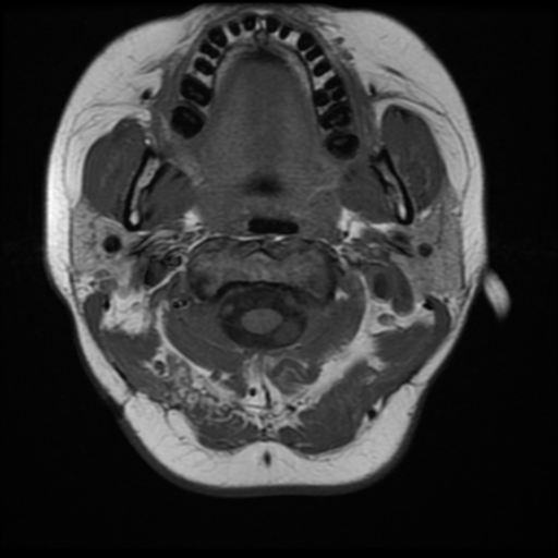 File:Neurofibromatosis type 2 (Radiopaedia 45229-49251 Axial T1 1).png