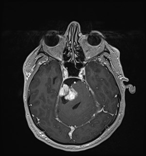 Neurofibromatosis type 2 (Radiopaedia 79097-92049 Axial T1 C+ 71).jpg