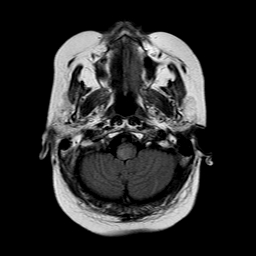 File:Neurofibromatosis type 2 (Radiopaedia 8713-9518 Axial FLAIR 22).jpg