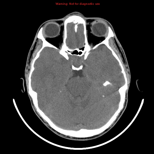 File:Neurofibromatosis type 2 (Radiopaedia 8953-9732 Axial non-contrast 12).jpg