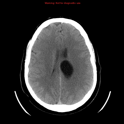 File:Neuroglial cyst (Radiopaedia 10713-11185 Axial non-contrast 13).jpg