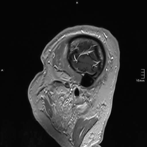 Neurosarcoidosis - involvement of the mesial temporal lobes (Radiopaedia 67429-76820 Sagittal T1 C+ 18).jpg