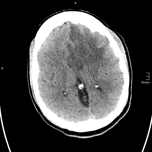 File:Neurotoxoplasmosis - concentric target sign (Radiopaedia 70644-80783 Axial non-contrast 20).jpg