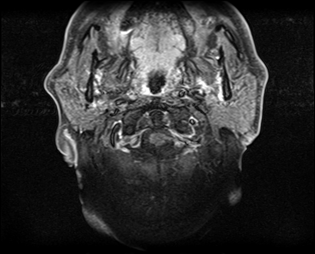 File:Non-Hodgkin lymphoma - parotid gland (Radiopaedia 71531-81890 Axial T1 C+ fat sat 16).jpg