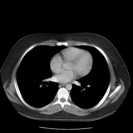 File:Non-Hodgkin lymphoma involving pelvis (Radiopaedia 21281-21197 A 1).jpg