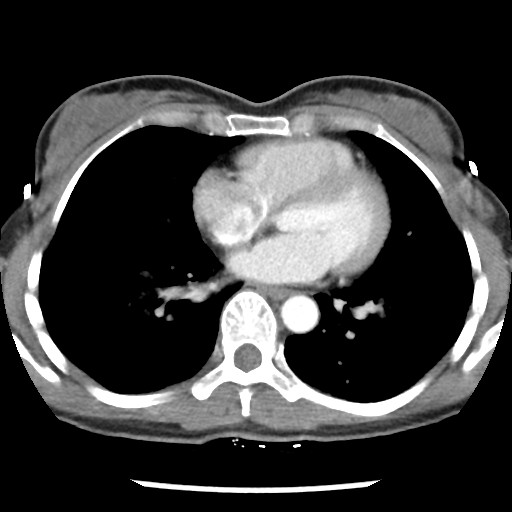 File:Non-small cell lung cancer with miliary metastases (Radiopaedia 23995-24193 A 26).jpg