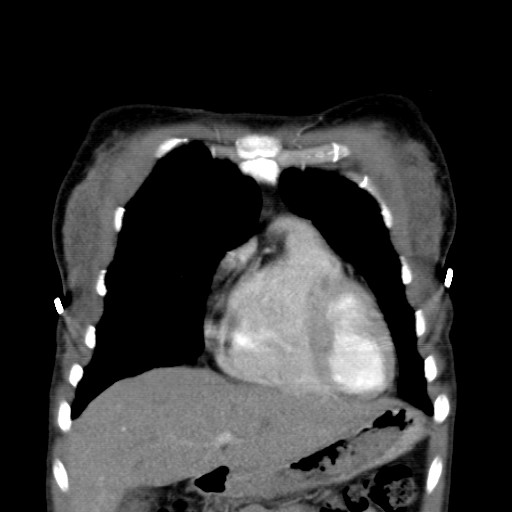 File:Non-small cell lung cancer with miliary metastases (Radiopaedia 23995-24193 B 4).jpg