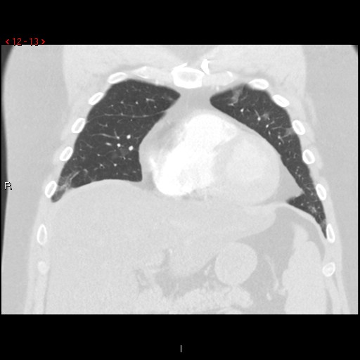 File:Non-specific interstitial pneumonitis (Radiopaedia 27044-27222 Coronal lung window 13).jpg