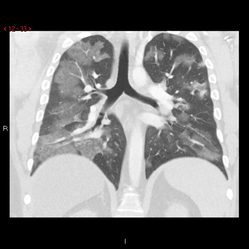 File:Non-specific interstitial pneumonitis (Radiopaedia 27044-27222 Coronal lung window 33).jpg