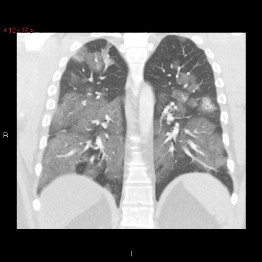 File:Non-specific interstitial pneumonitis (Radiopaedia 27044-27222 Coronal lung window 37).jpg