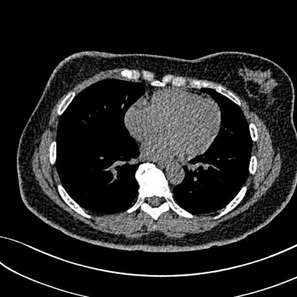 Normal CT chest- adult female (Radiopaedia 52522-58428 Axial non-contrast 82).jpg