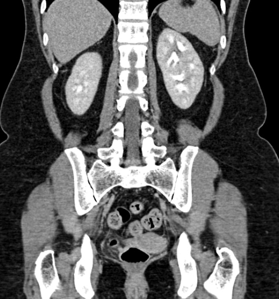 Normal CT intravenous urogram (Radiopaedia 39444-41759 A 324).jpg