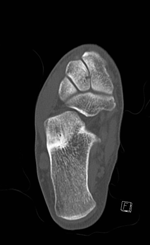 Normal CT of the ankle (Radiopaedia 47111-51658 Axial bone window 66).jpg