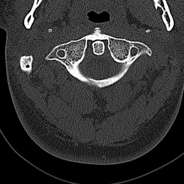Normal CT of the cervical spine (Radiopaedia 53322-59305 Axial bone window 62).jpg