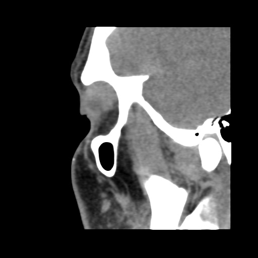Normal CT paranasal sinuses (Radiopaedia 42286-45390 F 119).jpg