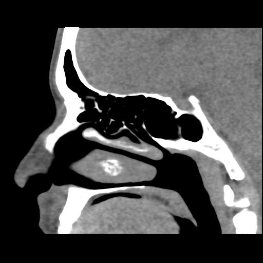 Normal CT paranasal sinuses (Radiopaedia 42286-45390 F 70).jpg