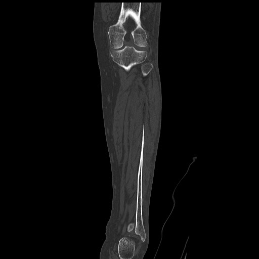 Normal CT tibia and fibula (Radiopaedia 51195-56848 Coronal non-contrast 41).jpg