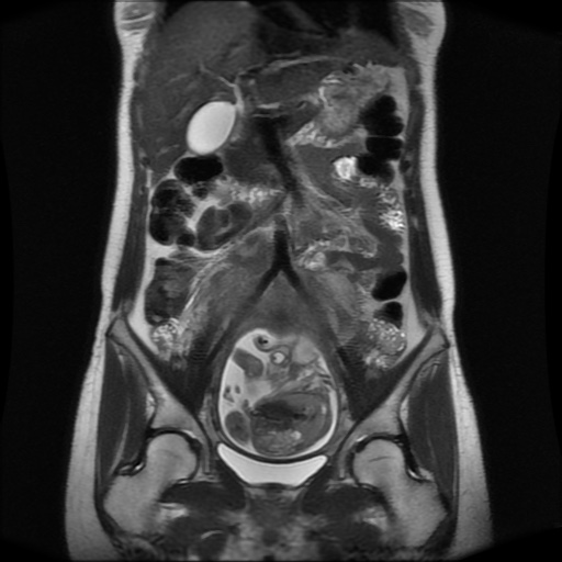 File:Normal MRI abdomen in pregnancy (Radiopaedia 88001-104541 Coronal T2 15).jpg