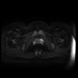 Normal MRI abdomen in pregnancy (Radiopaedia 88005-104548 Axial DWI 44).jpg