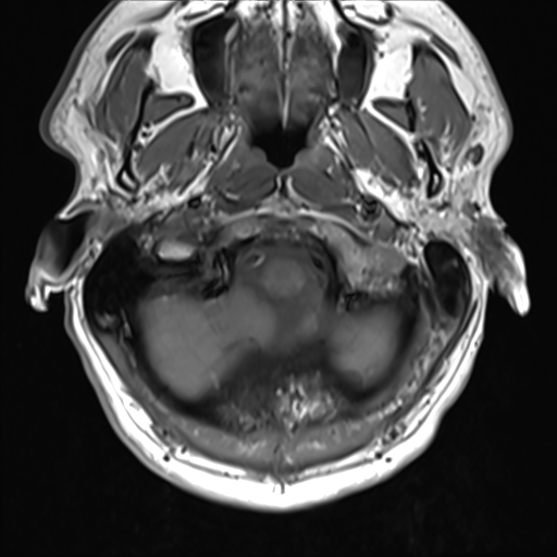 File:Normal MRI cervical spine (infection protocol) (Radiopaedia 53916-60039 Axial 6).png