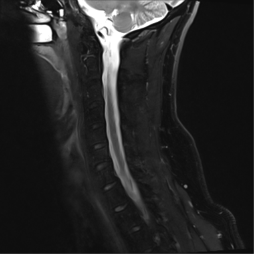 File:Normal MRI cervical spine (infection protocol) (Radiopaedia 53916-60039 Sagittal Dixon 6).png
