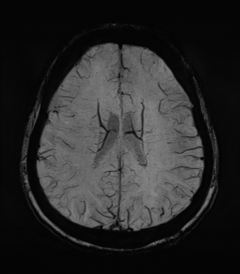 Normal MRI internal auditory canal (Radiopaedia 41613-44525 Axial SWI MIP 53).png