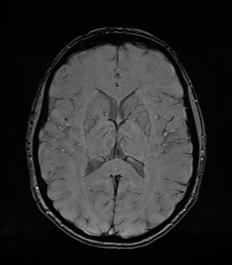 Normal brain MRI (TLE protocol) (Radiopaedia 40748-43405 Axial SWI 48).png
