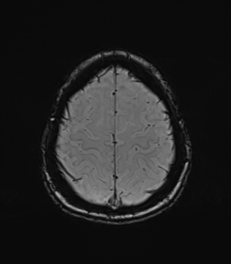 Normal brain MRI (TLE protocol) (Radiopaedia 40748-43405 Axial SWI 74).png