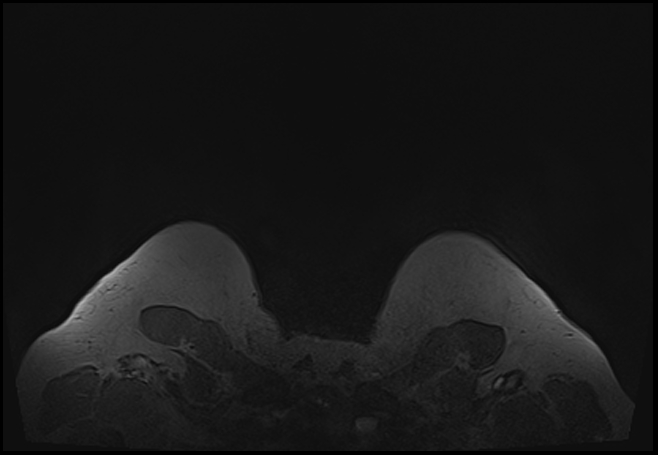 File:Normal breast MRI - dense breasts (Radiopaedia 80454-93850 Axial T1 223).jpg