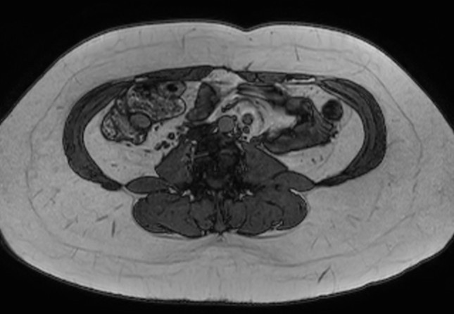 File:Normal liver MRI with Gadolinium (Radiopaedia 58913-66163 B 2).jpg