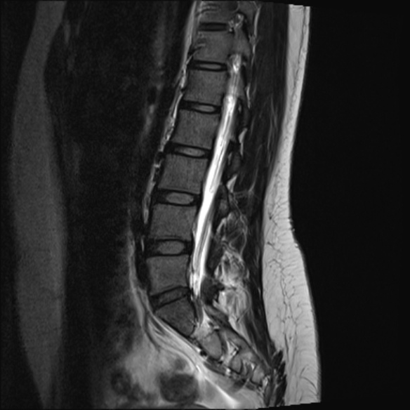 File:Normal lumbar spine MRI- 3 T (Radiopaedia 53280-59250 Sagittal T2 16).jpg