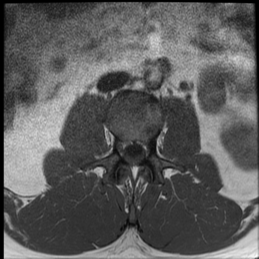 File:Normal lumbar spine MRI (Radiopaedia 35543-37039 Axial T1 30).png