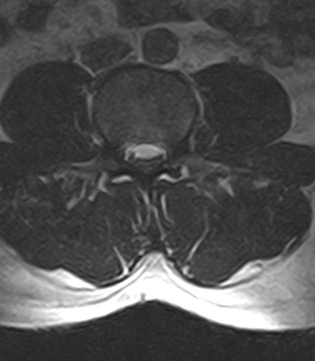 Normal lumbar spine MRI - low-field MRI scanner (Radiopaedia 40976-43699 Axial T2 55).jpg