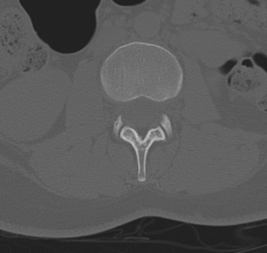 File:Normal lumbosacral CT (Radiopaedia 37923-39867 Axial bone window 47).png