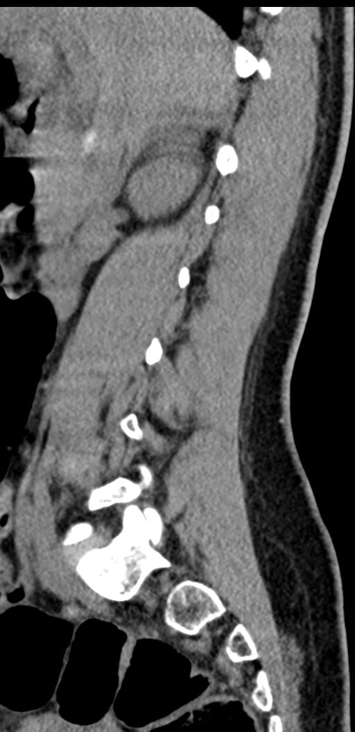Normal lumbosacral CT (Radiopaedia 37923-39867 E 74).png