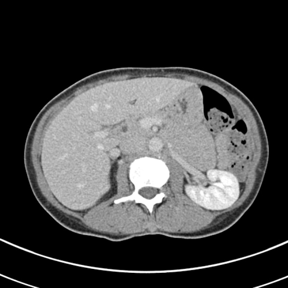 File:Normal multiphase CT liver (Radiopaedia 38026-39996 C 29).jpg