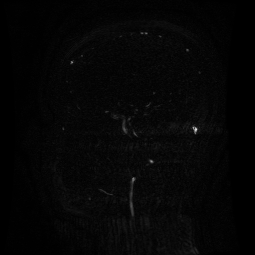 Normal noncontrast MR venography (Radiopaedia 87578-103957 A 104).jpg